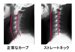 X-ray of normal neck and straight neck