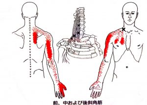 Trigger point for posterior scalene muscle