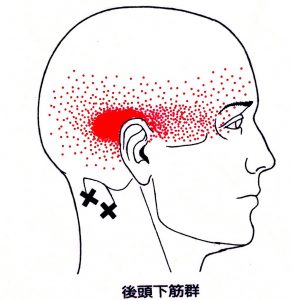  Trigger point for the suboccipital muscles