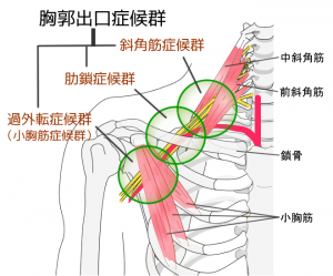 Thoracic outlet syndrome