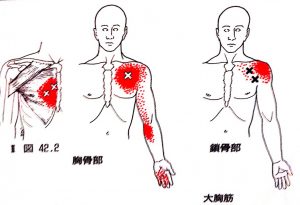 Pectoral muscle trigger point