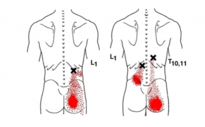 Trigger point for erector spinae muscles